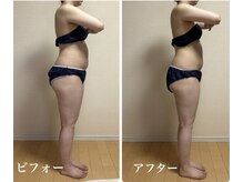 高槻 インサイド(Inside)/20代反り腰さんビフォーアフター