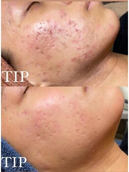 プランス 渋谷(PLANCE)/毛穴/ハーブ/ニキビケア