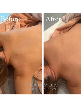 クリーンアンドビューティ 札幌(Clean&Beauty)/背中にハーブピーリング♪