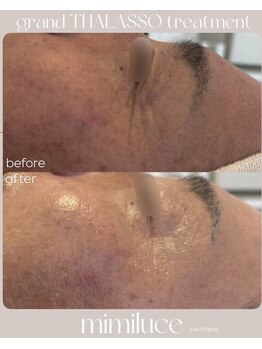 ミミルーチェ(mimiluce)/タラソトリートメント