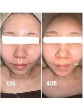 ミニョン(mignon)/20代モニター結果！