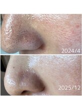 メープルサロン(MAPLE SALON)/毛穴の黒ずみの変化！