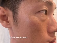 オアシスラグーン(OASIS LAGOON)/シミケア（症例３：after）