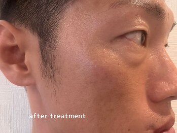 オアシスラグーン(OASIS LAGOON)/シミケア(症例3:after)