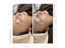 シャルムパリス(charme paris)/安定したお肌へ♪１回の施術変化