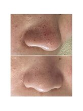 マヴィ 香里園店(MavY.)/毛穴洗浄1回