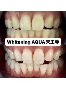 アクア 天王寺店(AQUA)/セルフホワイトニング/天王寺