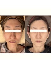 ビーチェ(BICE)/光フェイシャル3回目