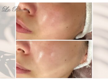 ラボーテ/ピーリング前処置