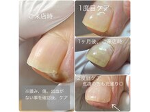 巻き爪フットケアサロン 神楽坂の雰囲気（施術後痛みから解放、切らない、目立たない巻き爪ケア◎）