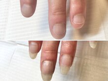 グラシュータン(gracieux temps)/深爪矯正