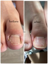 アウラ/巻き爪9ヶ月で卒業