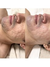 サロン ド シューナ(salon de schoner)/ハーブトリートメント3.0g 2回