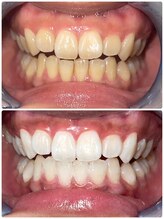 ココホワイトニング 天王寺店/ビフォーアフター５