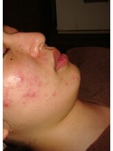 フリーダン(Freedom)/フェイシャル肌荒れでお悩みの方