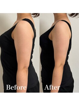 ホルバール 佐賀店(Hallbar)/スッキリ二の腕美人！