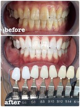 エクシアホワイトニング 徳島店/40代プレミアムホワイトニング例