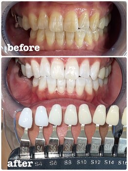 エクシアホワイトニング 徳島店/40代プレミアムホワイトニング例