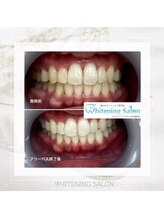 ホワイトニングサロン 名古屋駅店/【ホワイトニング施術例】