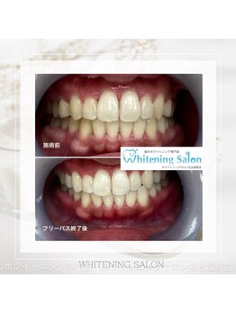 ホワイトニングサロン 名古屋駅店/【ホワイトニング施術例】