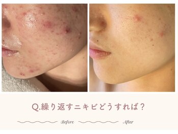 オートクチュール エステティックサロン シーズ/Q.繰り返すニキビどうすれば？