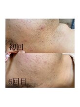 カウピリ(kaupili)/【脱毛】ビフォーアフター