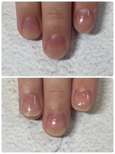 ソネル(SONEL)/美育爪矯正