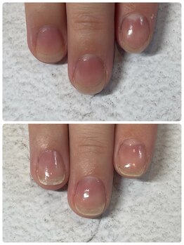 ソネル(SONEL)/美育爪矯正