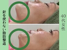 ソルニス(Solnis.)/小顔☆脂肪分解/ハイパーナイフ