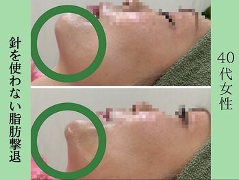 ソルニス(Solnis.)/小顔☆脂肪分解/ハイパーナイフ