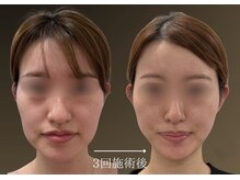 ミャオ(Meow!)/チタニウムリフト