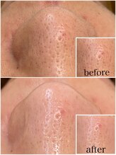 毛穴専科/毛穴洗浄+白玉ワックス メンズ◎