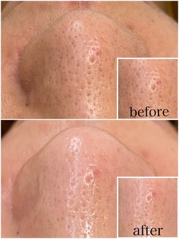 毛穴専科/毛穴洗浄+白玉ワックス メンズ◎