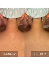 サンベリーナ(Thumbelina)/シンデレラケア