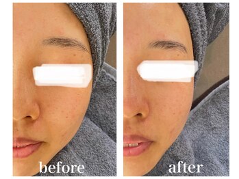 ルー ハナレ 神戸岡本 摂津本山店(Luu HANARE)/小顔リフトアップ　５回