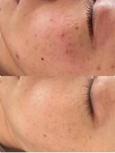 ラエッセ 目黒 白金台店(LAESSE)/毛穴・美白専門店 LAESSE 白金台