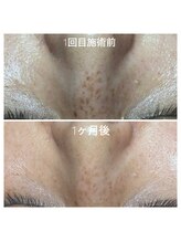 アマラ(Amarra)/気になるお鼻のシミも