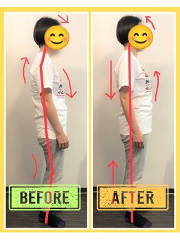 やくいん整骨院 薬院店/姿勢ビフォーアフター