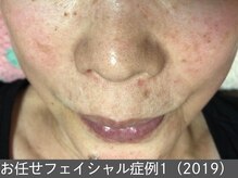 オアシスラグーン(OASIS LAGOON)/お任せフェイシャル（症例1）