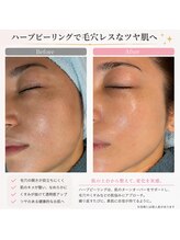 ランファビューティー(蘭花Beauty)/ハーブピーリングで毛穴レス美肌