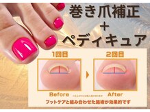 ネイルサロン オー(Oh!)/フット限定　☆巻き爪矯正☆