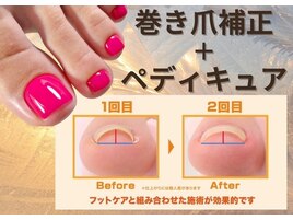 フット限定　☆巻き爪矯正☆