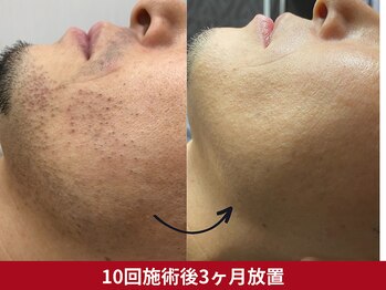 美容脱毛専門サロン エピラージュ 新宿店(Epilage)/メンズヒゲ脱毛