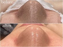 シルク ド リバー 銀座店(Silk de River)/ハイドロ+エクストラクション