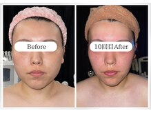 ガーネ 堺店(GARNE)/小顔・リフトアップ10回/20代