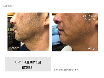 フェレザ 新潟(Felleza)/セルフで手軽にヒゲ脱毛