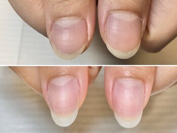 グラシュータン(gracieux temps)/深爪矯正