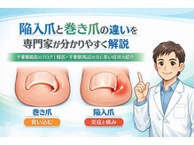 巻き爪じゅん 千葉駅前店/陥入爪と巻き爪の違い院長が解説