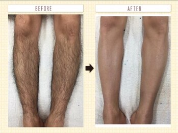 ルイ(Rui)/男性も清潔感！足脱毛！