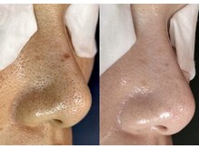 《毛穴エステ》黒ずみ、開きに◎人生変わるお肌メンテナンス！